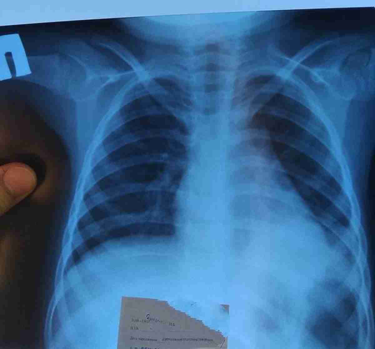 Китай заявил об чрезвычайно опасной эпидемии пневмонии в Казахстане